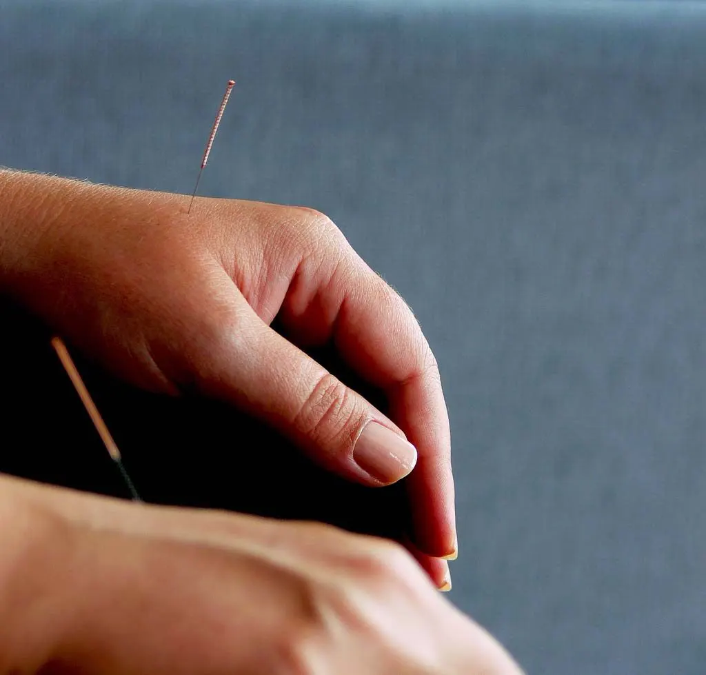 Acupuncture Treatment in Springfield, IL Near Me Acupuncturist